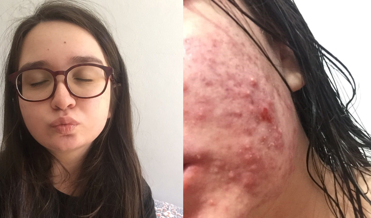 Como o estresse afeta a pele e causa espinhas na testa?