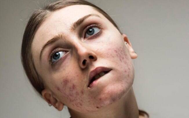 Dicas de higiene para prevenir espinhas na testa