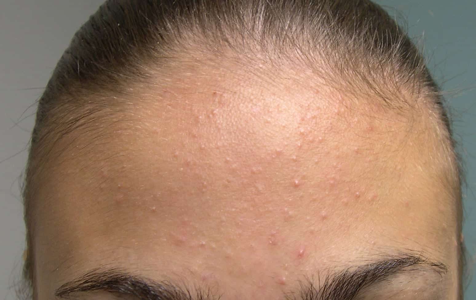 Produtos capilares: o vilão invisível das espinhas na testa