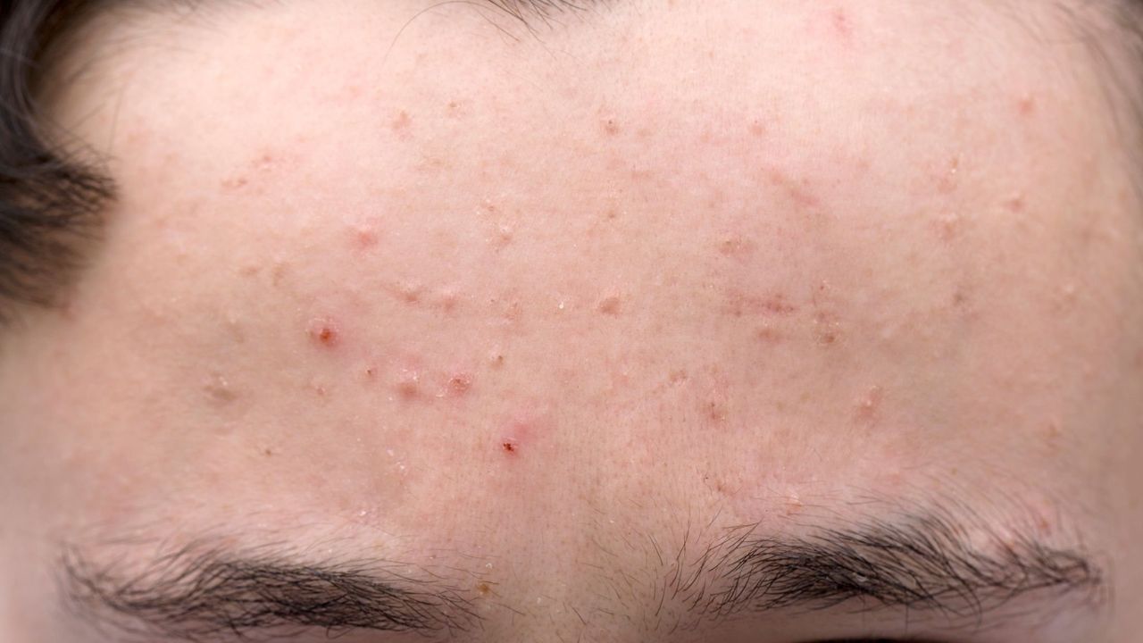 Dicas de higiene para prevenir espinhas na testa