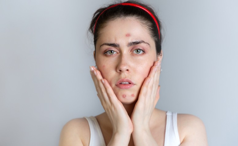 Espinhas Na Testa De Repente