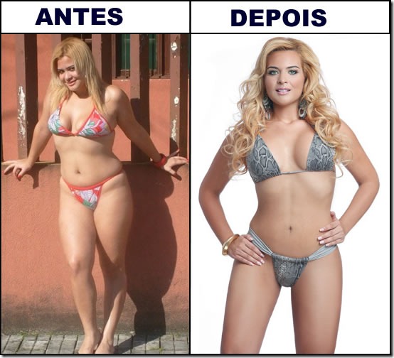 Ninfoplastia: A experiência de Geisy Arruda e seus benefícios para a autoestima