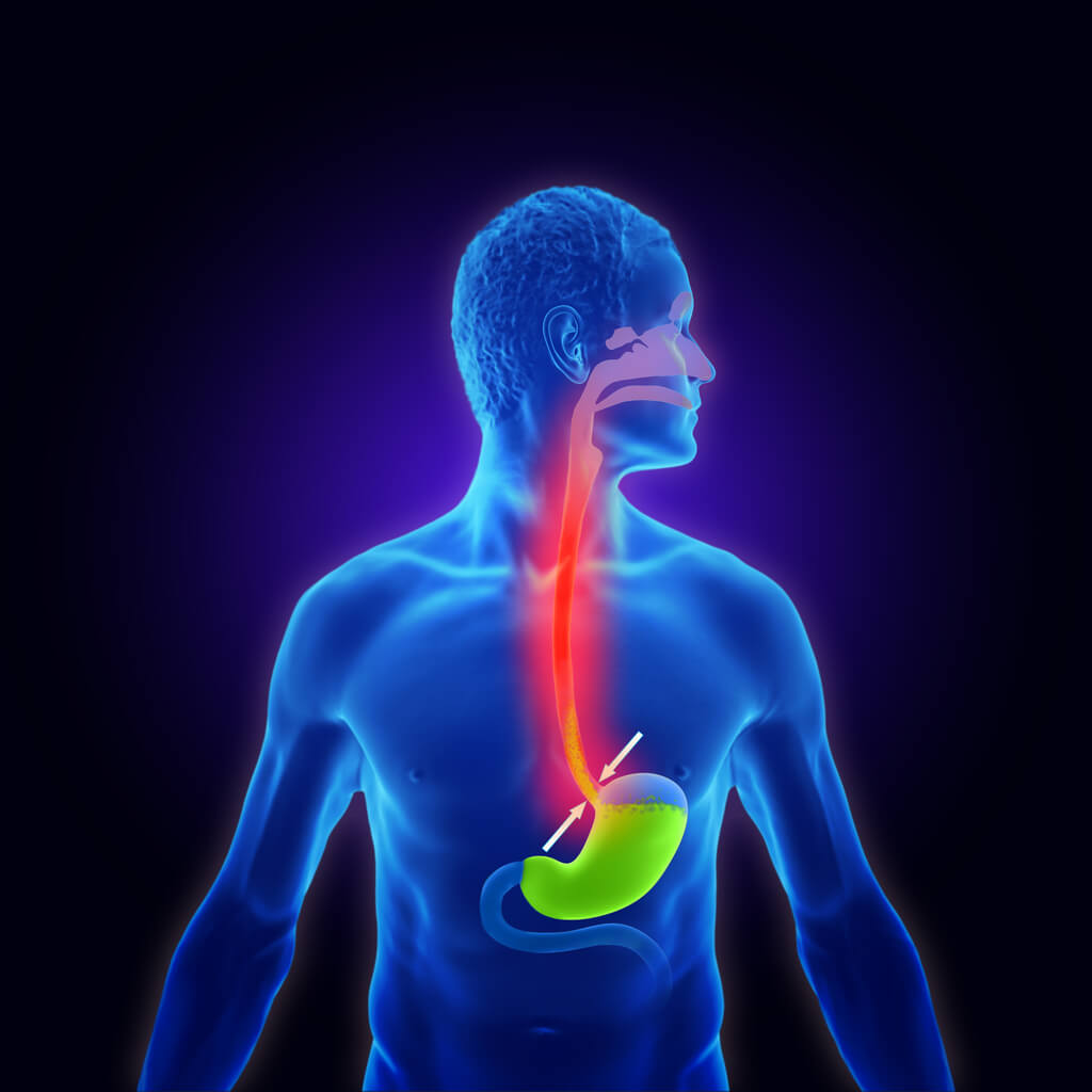 Gastrite vs. Refluxo: Entenda as Diferenças e Sintomas