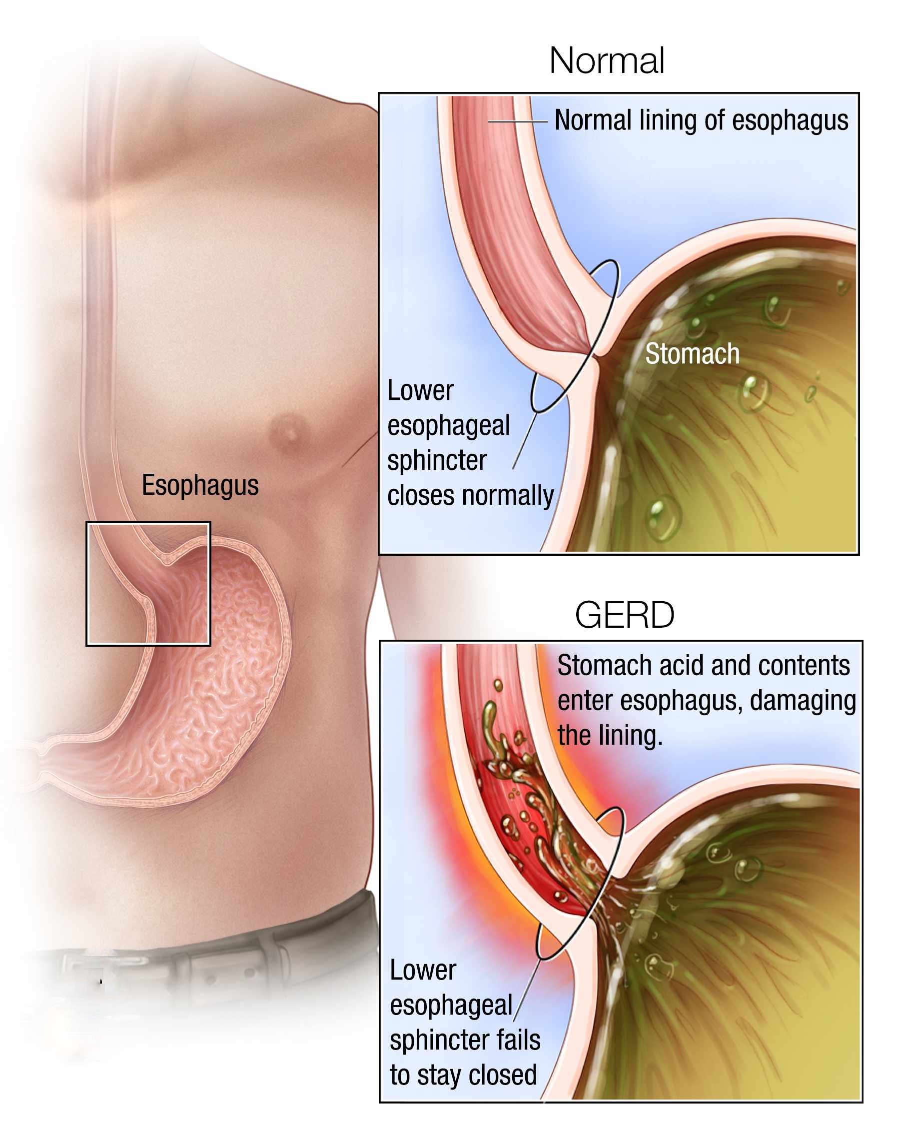 Remédios Caseiros para Aliviar a Dor no Estômago Rapidamente