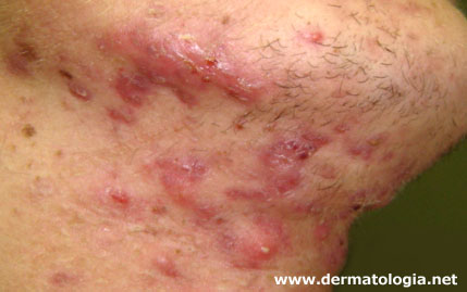 Quais os melhores leites vegetais para uma pele sem acne?