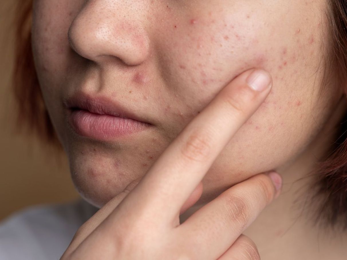 Dieta anti-acne: alimentos para incluir e evitar