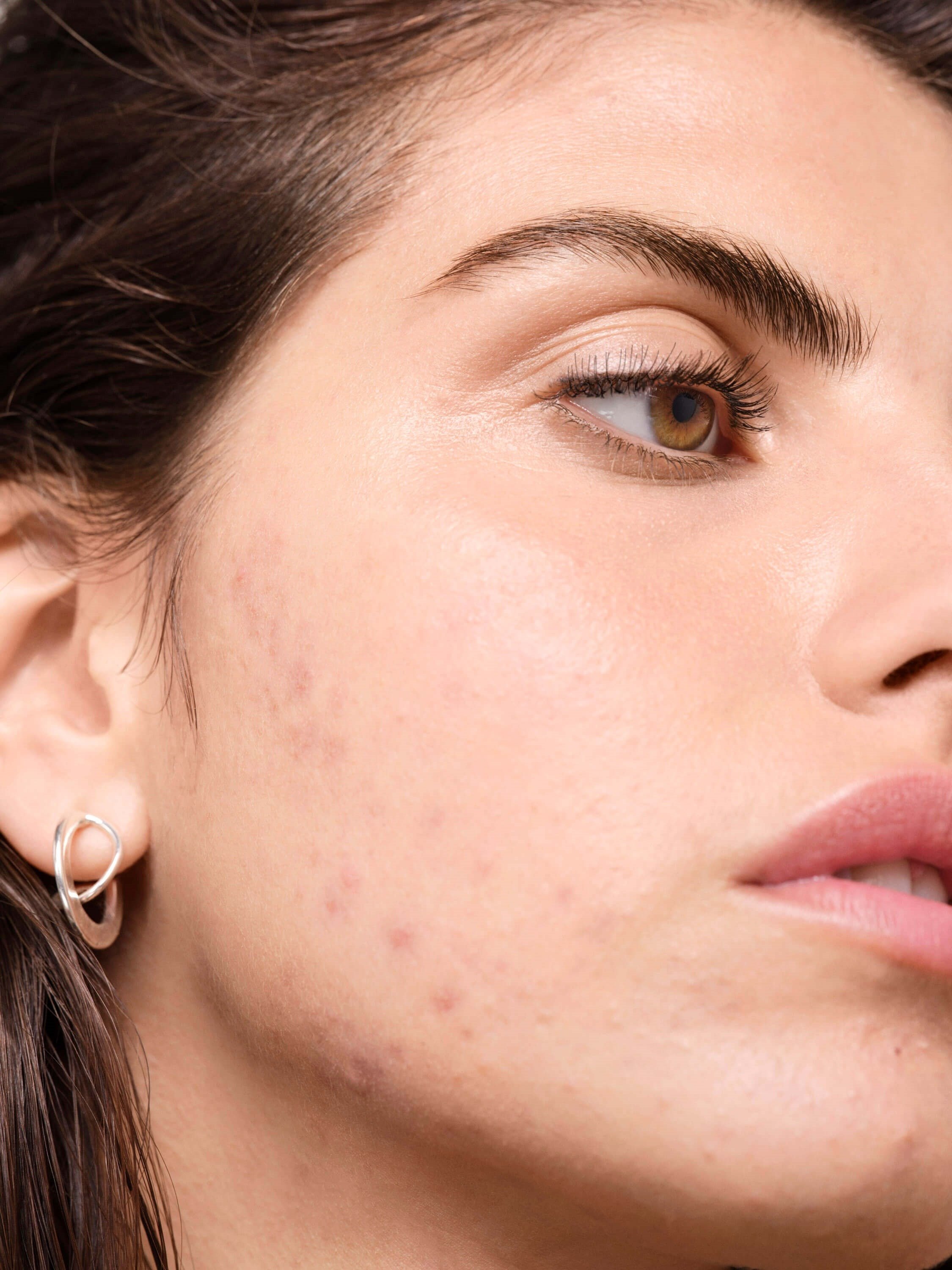 Leite desnatado vs. integral: qual é o pior para a acne?