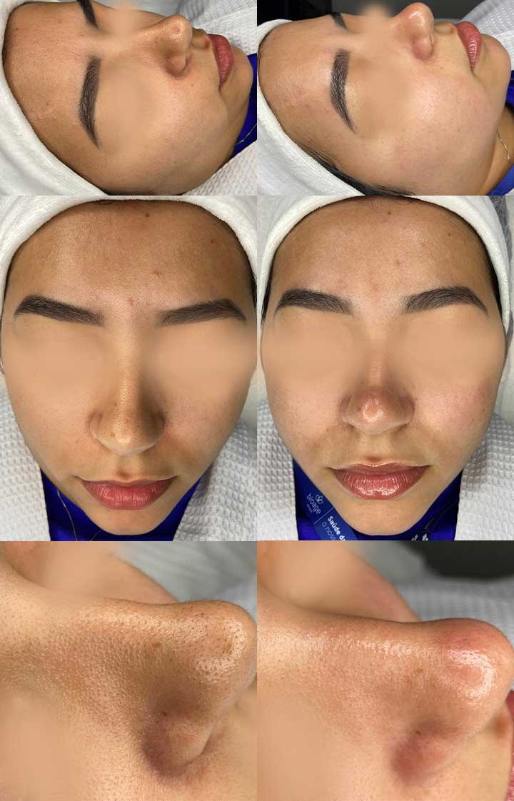 Acne e Melasma: Cuidados Específicos na Limpeza de Pele