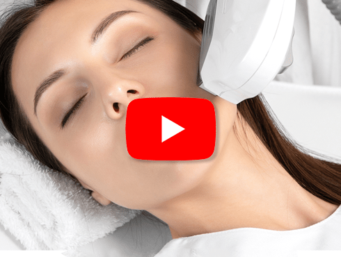 luz pulsada para acne