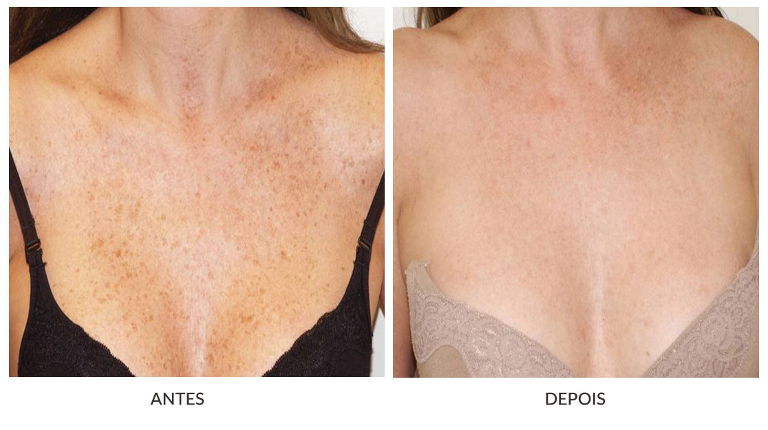 luz pulsada para rejuvenescimento