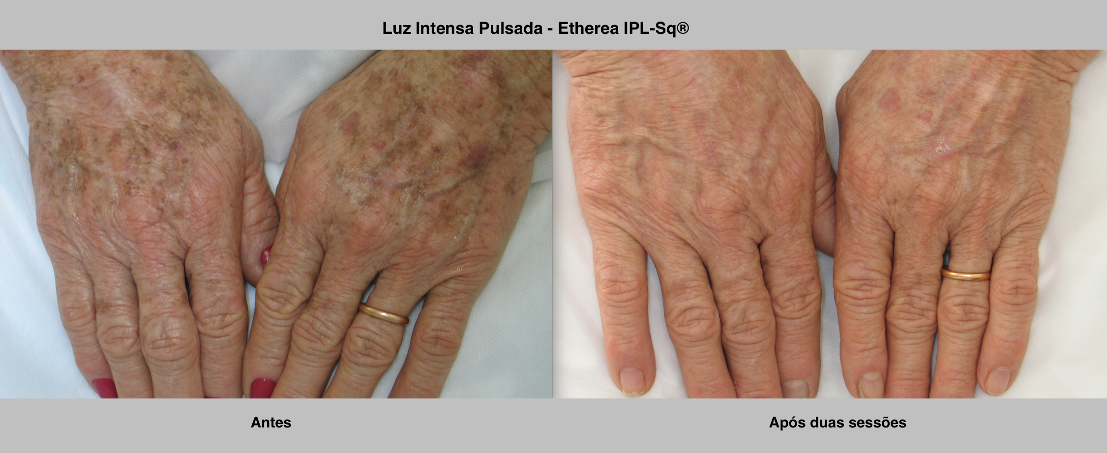 antes e depois luz pulsada