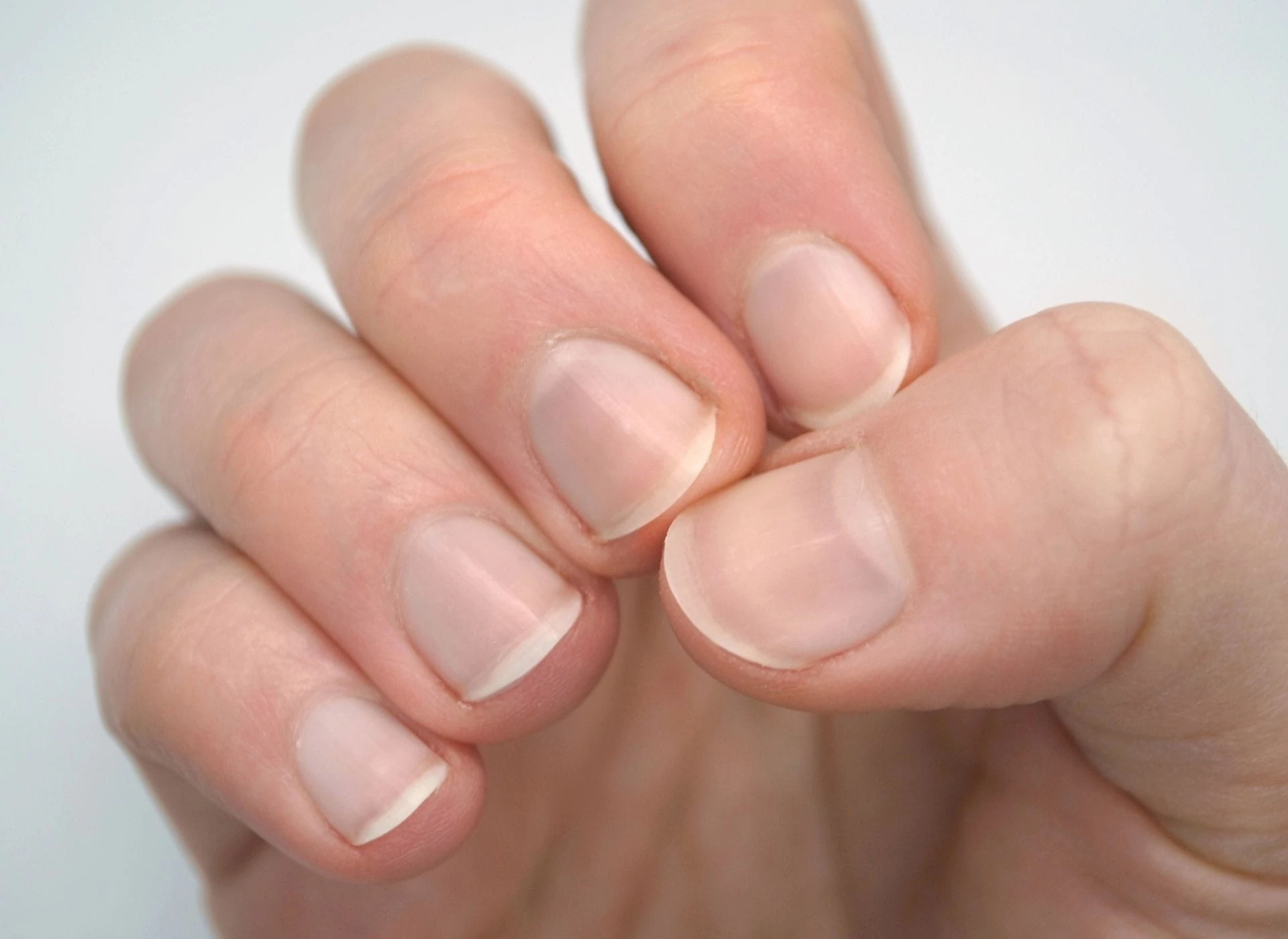 o que fazer se sua mancha na unha piorar