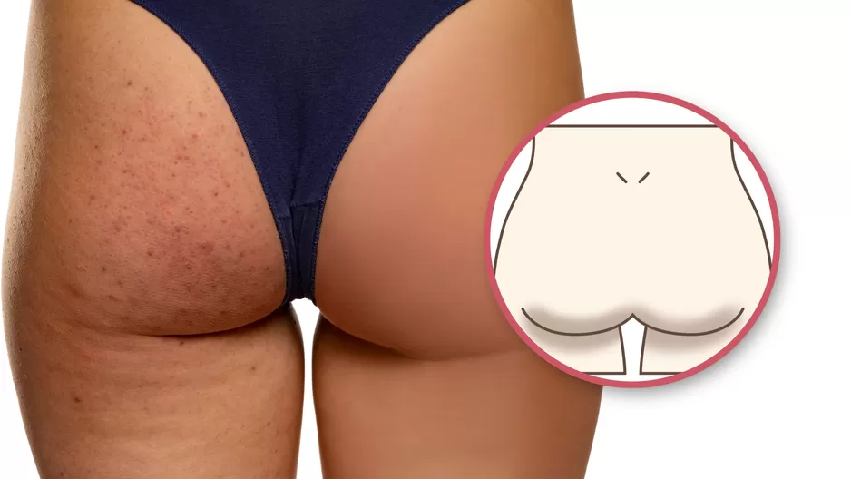 5 ideias de títulos:
1. Guia Completo: Como Eliminar Manchas e Foliculite nos Glúteos
2. Os Melhores Ingredientes para Clarear e Uniformizar a Pele do Bumbum
3. Foliculite: Causas