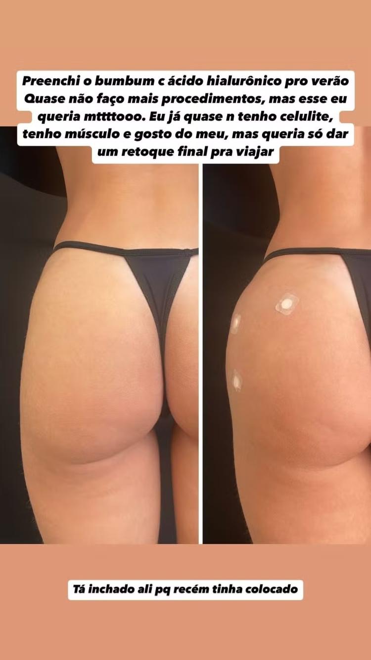 5 ideias de títulos:
1. Guia Completo: Como Eliminar Manchas e Foliculite nos Glúteos
2. Os Melhores Ingredientes para Clarear e Uniformizar a Pele do Bumbum
3. Foliculite: Causas
