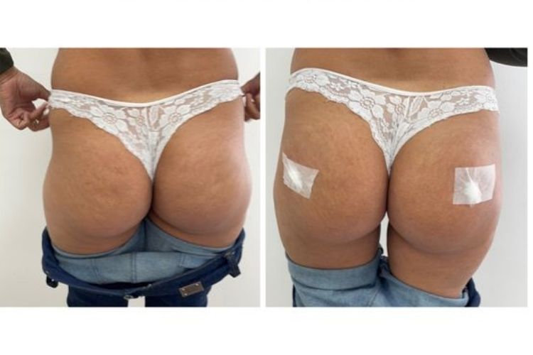 5 ideias de títulos:
1. Guia Completo: Como Eliminar Manchas e Foliculite nos Glúteos
2. Os Melhores Ingredientes para Clarear e Uniformizar a Pele do Bumbum
3. Foliculite: Causas