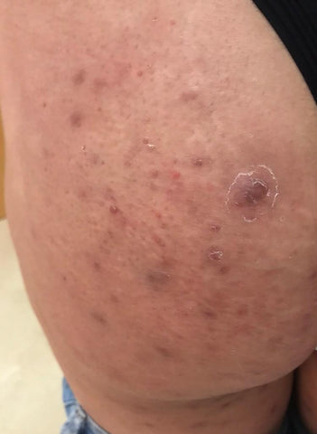 Prevenção e Tratamentos Eficazes para os Glúteos
4. Acabe com as Manchas: Dicas de Higiene e Cuidados para os Glúteos
5. Quando Procurar um Dermatologista para Manchas nos Glúteos?