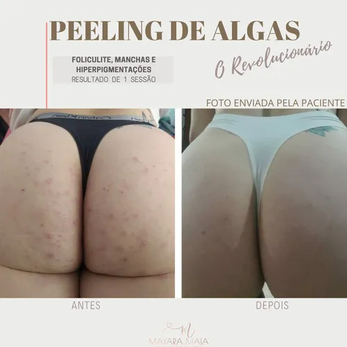 Prevenção e Tratamentos Eficazes para os Glúteos
4. Acabe com as Manchas: Dicas de Higiene e Cuidados para os Glúteos
5. Quando Procurar um Dermatologista para Manchas nos Glúteos?
