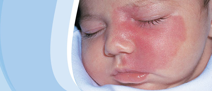 Mancha Vinho do Porto na Pele: Causas