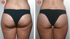 Manthus Antes E Depois