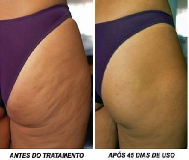 Manthus Antes E Depois