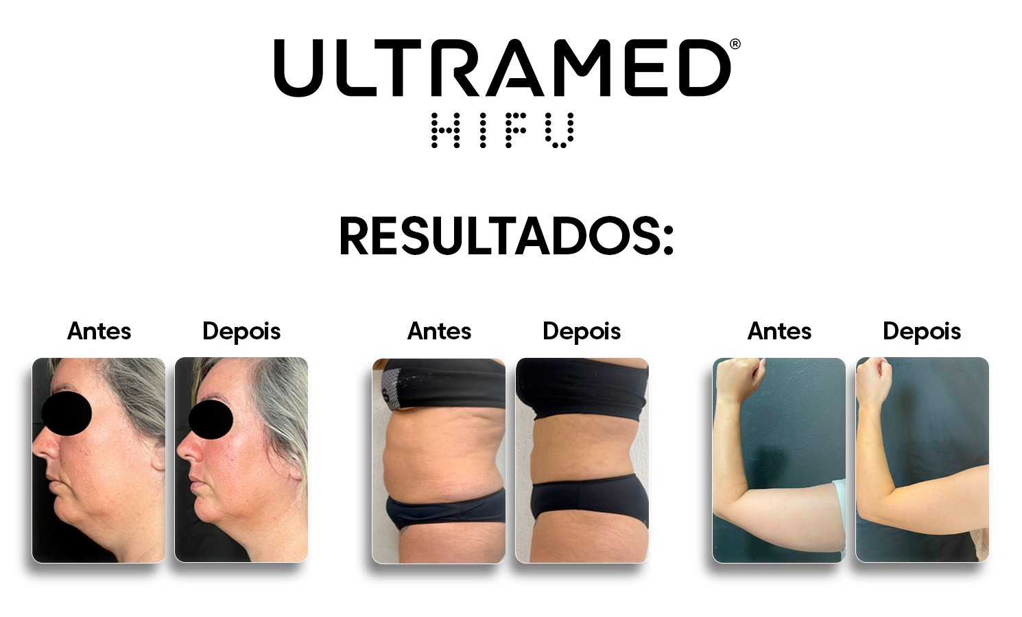 Manthus Antes E Depois