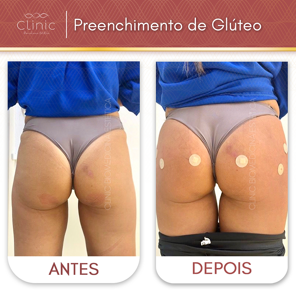 Manthus Antes E Depois
