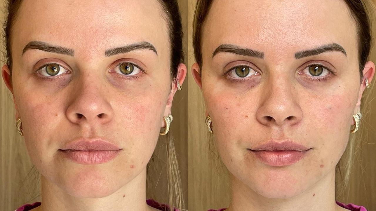 melhores resultados sculptra antes e depois