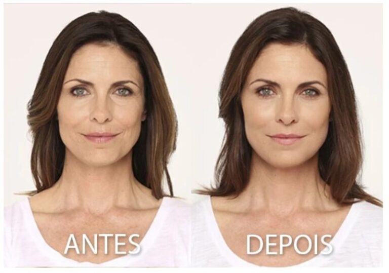 sculptra deu errado o que fazer