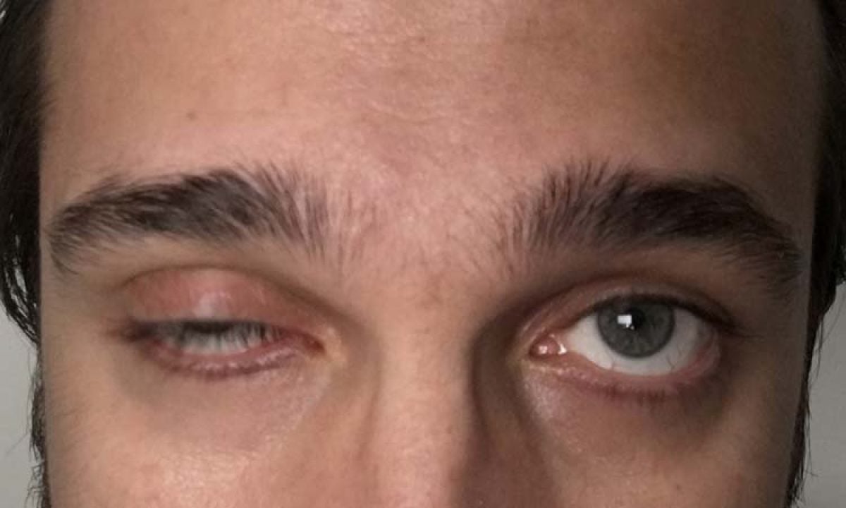 5 ideias de títulos:
1. Miastenia Gravis: Entendendo os Sintomas e o Diagnóstico.
2. Tratamentos Inovadores para Miastenia Gravis: Um Guia Completo.
3. Vivendo com Miastenia Gravis: Dicas de Manejo e Qualidade de Vida.
4. Miastenia Gravis em Jovens e Idosos: Desafios e Abordagens Específicas.
5. A Importância do Diagnóstico Precoce da Miastenia Gravis.