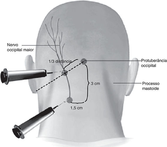 Guia Completo: Exercícios de Fisioterapia para Neuralgia Occipital
