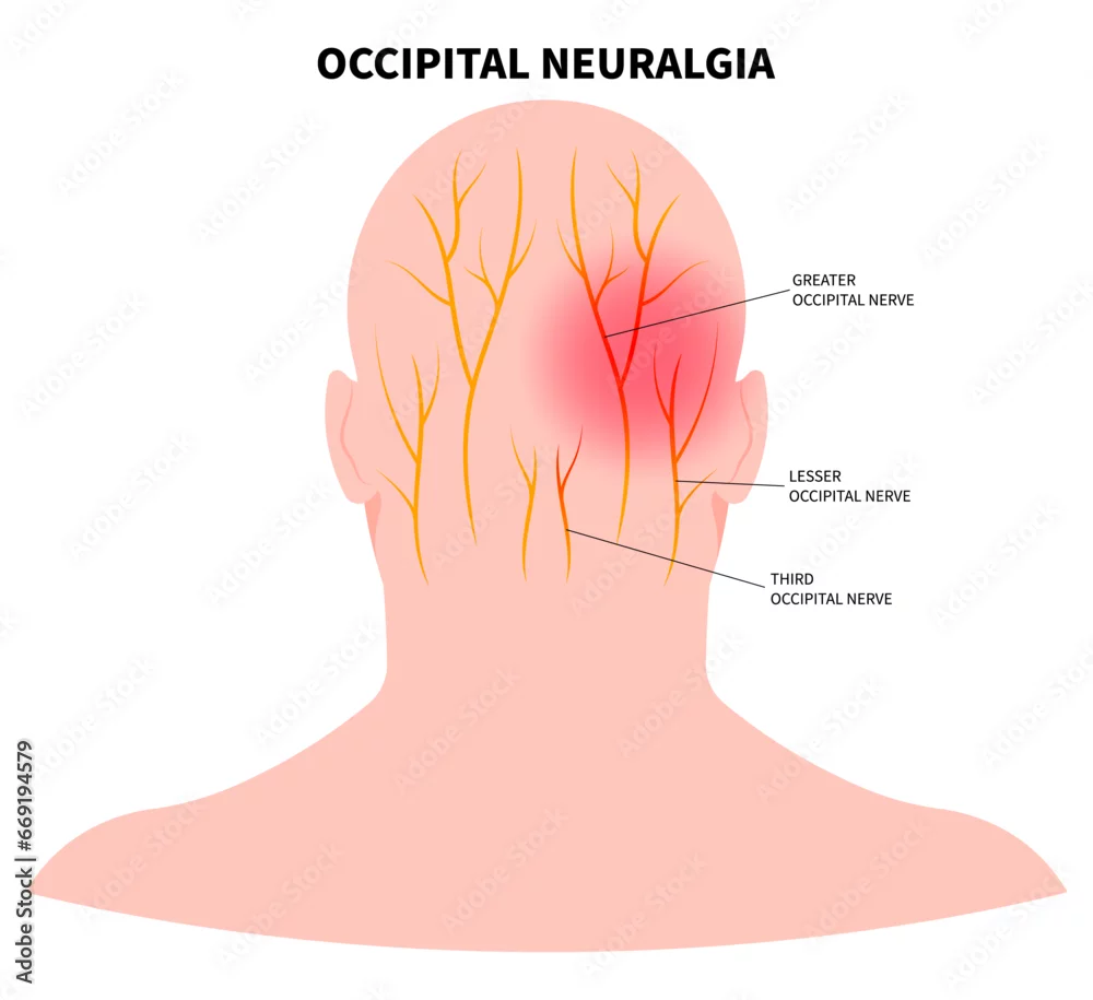 Medicamentos para Neuralgia Occipital: Opções e Efeitos Colaterais