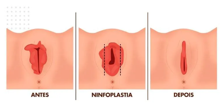 1. Cuidados Pós-Operatórios da Ninfoplastia: O Que Esperar?
2. Tempo de Recuperação da Labioplastia: Guia Completo
3. Ninfoplastia a Laser vs. Técnicas Tradicionais: Qual a Melhor?
4. Como Escolher o Cirurgião Plástico Ideal para sua Ninfoplastia
5. Benefícios e Riscos da Cirurgia Íntima: Tudo o Que Você Precisa Saber