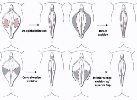 1. Cuidados Pós-Operatórios da Ninfoplastia: O Que Esperar?
2. Tempo de Recuperação da Labioplastia: Guia Completo
3. Ninfoplastia a Laser vs. Técnicas Tradicionais: Qual a Melhor?
4. Como Escolher o Cirurgião Plástico Ideal para sua Ninfoplastia
5. Benefícios e Riscos da Cirurgia Íntima: Tudo o Que Você Precisa Saber