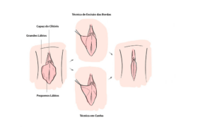 Ninfoplastia Tecnica