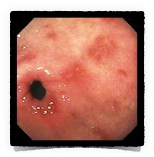 O Que E Gastrite Enantematosa