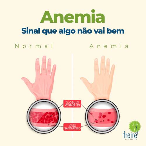 Sintomas e Opções de Tratamento