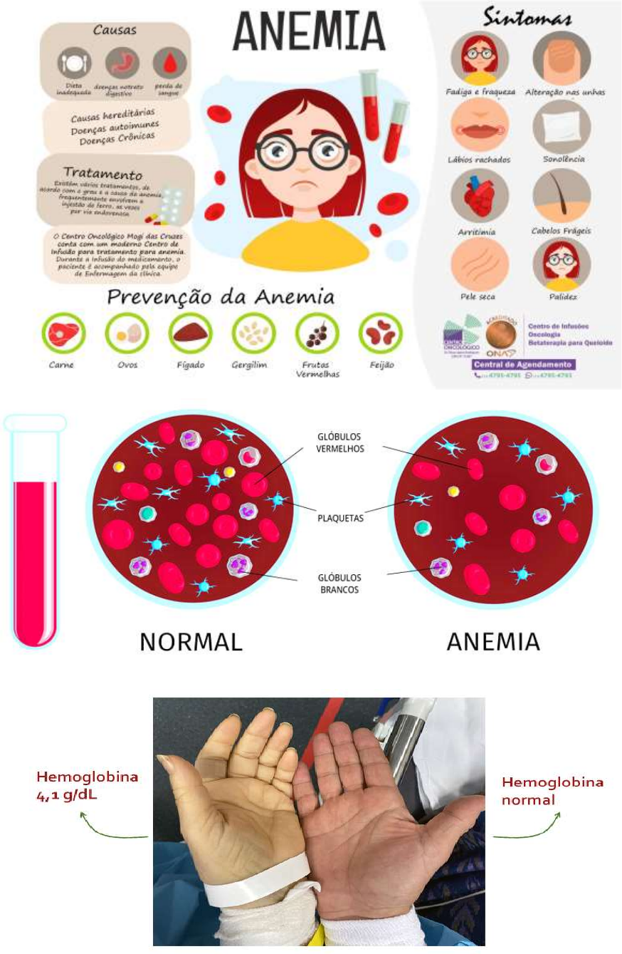 Dieta para Anemia: Alimentos Ricos em Ferro e Vitaminas Essenciais