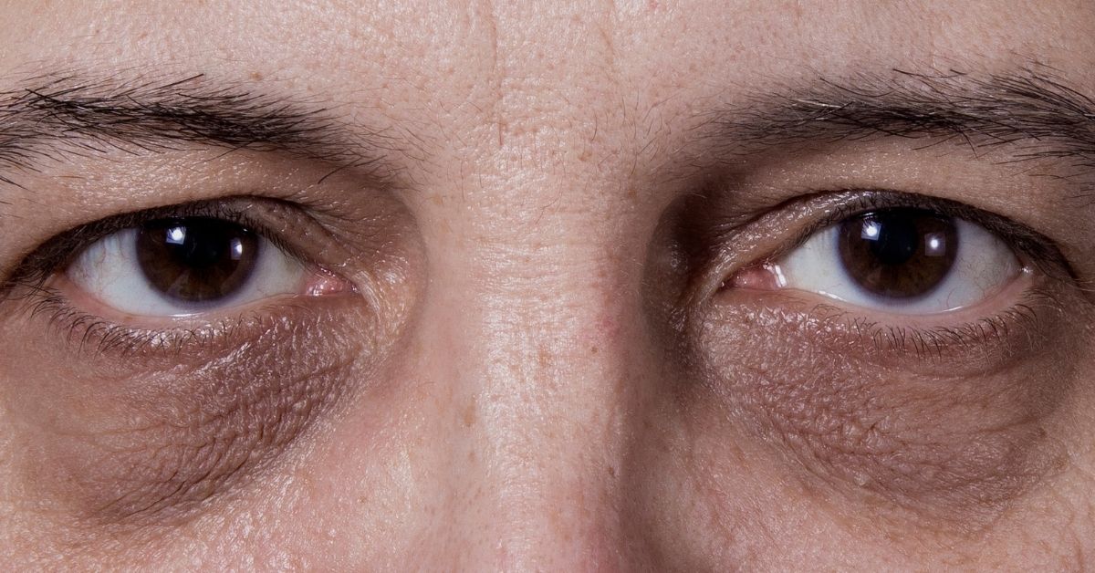 Guia Completo de Skincare: Os Melhores Ativos para Olheiras Escuras