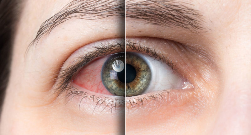 5 ideias de títulos:
1. Olho Seco: Guia Completo de Sintomas e Causas
2. Tratamentos Eficazes para Aliviar o Desconforto do Olho Seco
3. Como Fatores Ambientais e Hormonais Afetam a Saúde Ocular
4. Olho Seco e Lentes de Contato: Mitos e Verdades
5. Prevenção e Cuidados Essenciais para Olhos Saudáveis