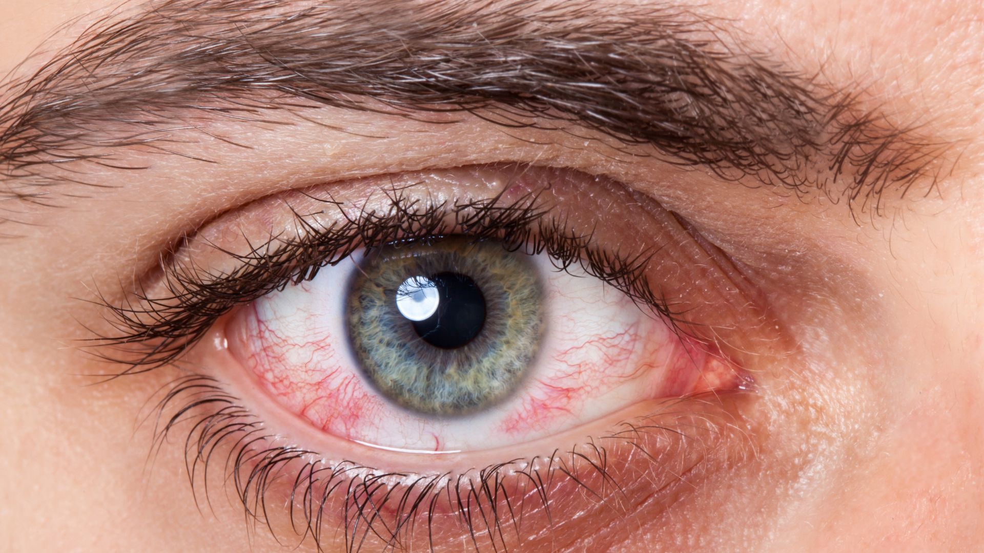 5 ideias de títulos:
1. Olho Seco: Guia Completo de Sintomas e Causas
2. Tratamentos Eficazes para Aliviar o Desconforto do Olho Seco
3. Como Fatores Ambientais e Hormonais Afetam a Saúde Ocular
4. Olho Seco e Lentes de Contato: Mitos e Verdades
5. Prevenção e Cuidados Essenciais para Olhos Saudáveis