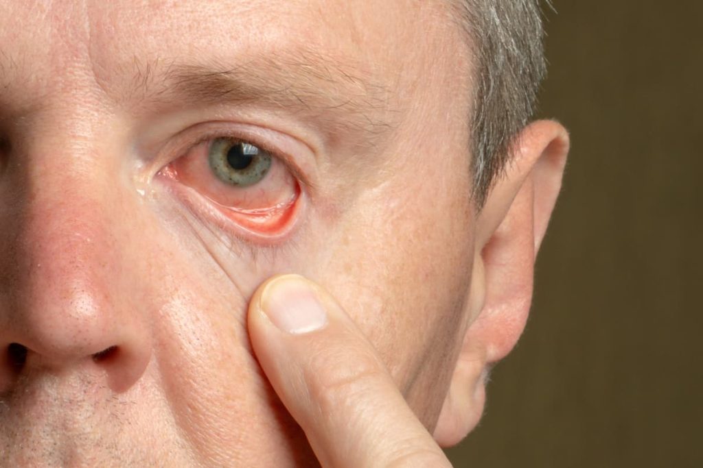 5 ideias de títulos:
1. Olho Seco: Guia Completo de Sintomas e Causas
2. Tratamentos Eficazes para Aliviar o Desconforto do Olho Seco
3. Como Fatores Ambientais e Hormonais Afetam a Saúde Ocular
4. Olho Seco e Lentes de Contato: Mitos e Verdades
5. Prevenção e Cuidados Essenciais para Olhos Saudáveis