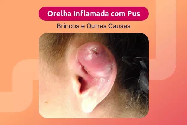 5 ideias de títulos:
1. Orelha Inflamada por Brinco: Guia Completo de Causas e Tratamentos
2. Sinais de Alerta: Quando Procurar um Médico para Orelha Inflamada
3. Higienização e Cuidados Essenciais para Prevenir Inflamações em Furos de Brincos
4. Alergia a Brincos: Identificando e Lidando com a Inflamação
5. Pericondrite: O Risco Oculto por Trás da Inflamação na Cartilagem da Orelha