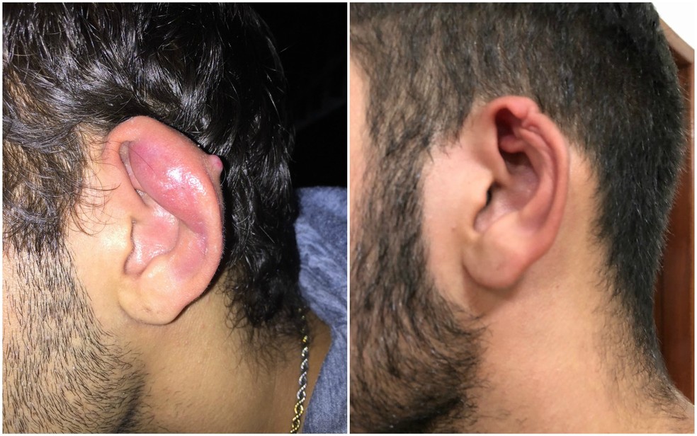 Orelha Inflamada Por Brinco