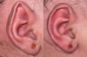 5 ideias de títulos:
1. Orelha Inflamada por Brinco: Guia Completo de Causas e Tratamentos
2. Sinais de Alerta: Quando Procurar um Médico para Orelha Inflamada
3. Higienização e Cuidados Essenciais para Prevenir Inflamações em Furos de Brincos
4. Alergia a Brincos: Identificando e Lidando com a Inflamação
5. Pericondrite: O Risco Oculto por Trás da Inflamação na Cartilagem da Orelha