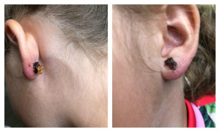 Orelha Inflamada Por Brinco