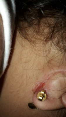 5 ideias de títulos:
1. Orelha Inflamada por Brinco: Guia Completo de Causas e Tratamentos
2. Sinais de Alerta: Quando Procurar um Médico para Orelha Inflamada
3. Higienização e Cuidados Essenciais para Prevenir Inflamações em Furos de Brincos
4. Alergia a Brincos: Identificando e Lidando com a Inflamação
5. Pericondrite: O Risco Oculto por Trás da Inflamação na Cartilagem da Orelha