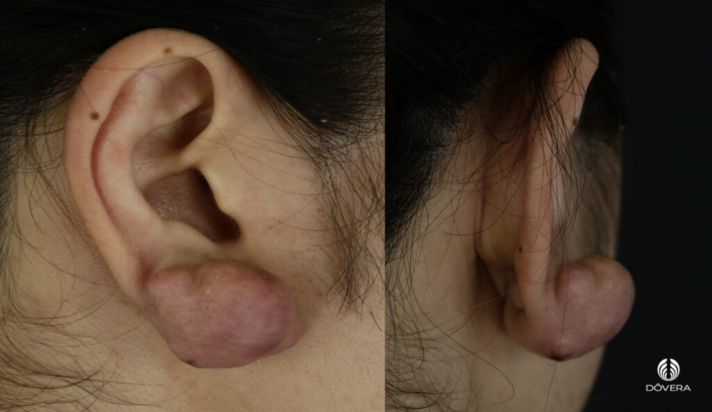 Orelha Inflamada Por Brinco