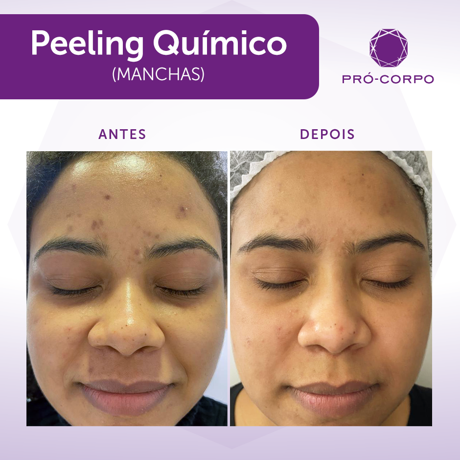 Peeling de Diamante: O Guia Completo de Cuidados Pré e Pós-Tratamento