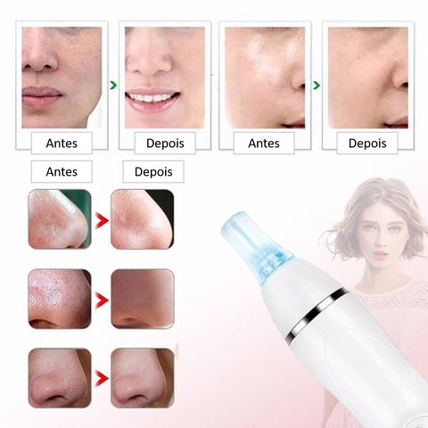 Quantas Sessões de Peeling de Diamante Você Precisa para uma Pele Perfeita?
