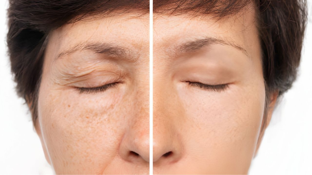 Comparativo: Peeling de Diamante vs. Peeling Químico – Qual o Melhor para Sua Pele?